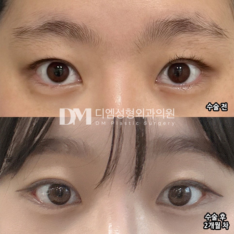 DM Lateral and Lower Canthoplasty Surgery Review, “I’m Satisfied with the Results Because My Eyes Look Wider Horizontally!” image 2