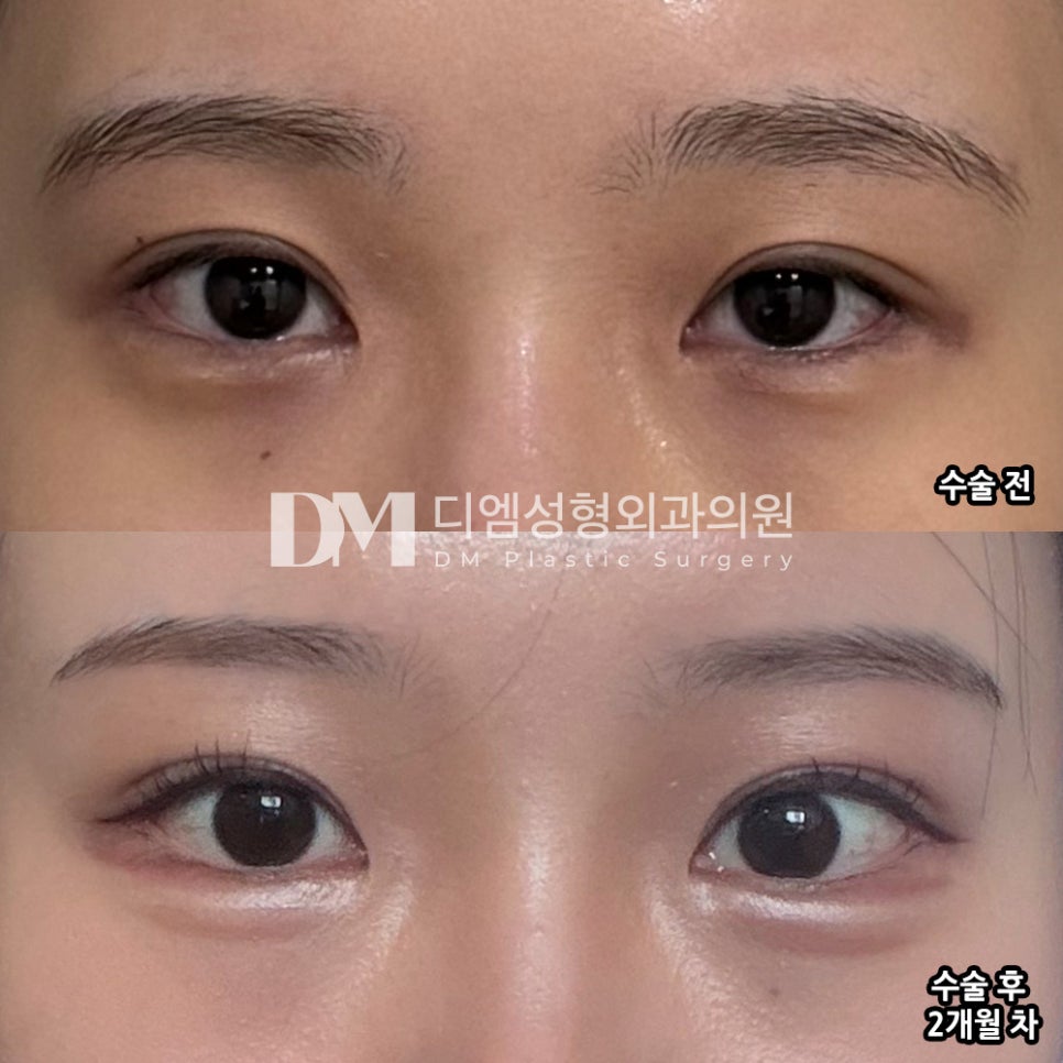 눈성형 후기."빠르게 일상 복귀가 가능해 좋았어요!" 관련 이미지 2