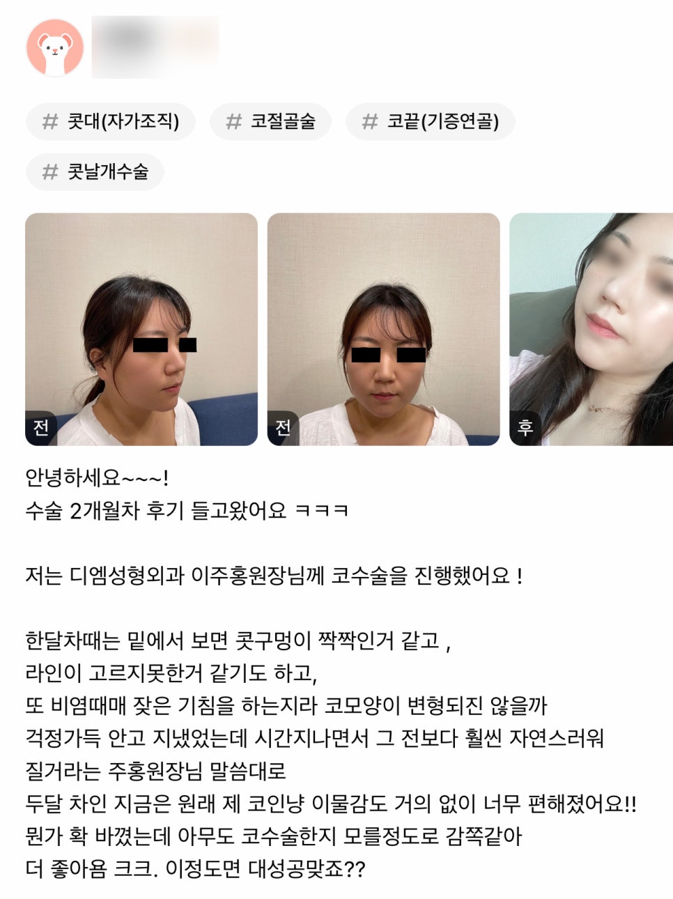 Nose Surgery Review. “I like it even more because it looks so natural that no one can tell I had nose surgery!” image 1