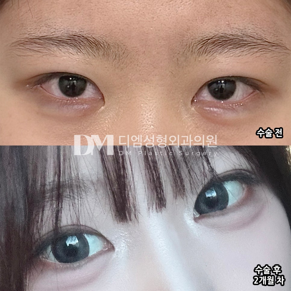 디엠 눈재수술 수술후기, &ldquo;처음부터 여기서 수술할 걸 그랬나 후회했어요!&rdquo; 관련 이미지 2