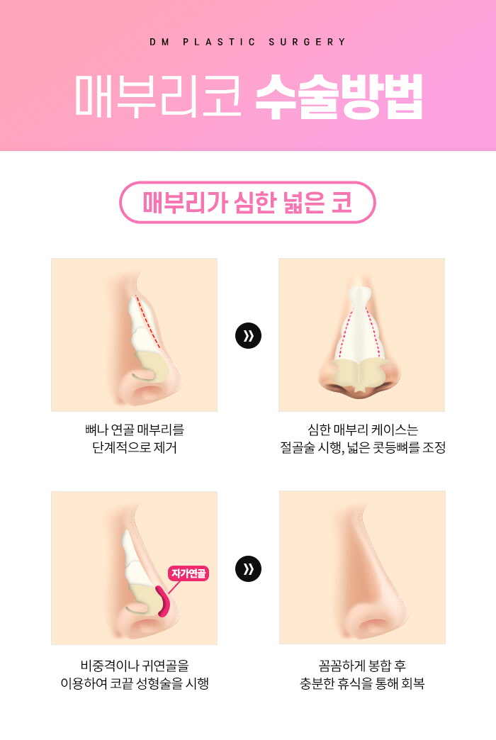 Perfecting Hump Nose Surgery with a Customized Surgical Plan image 5