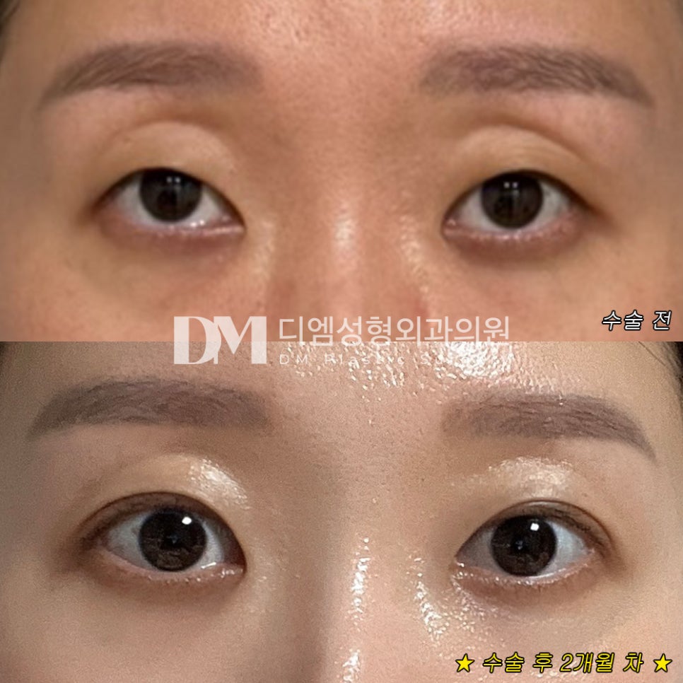 눈성형 후기."너무나도 자연스럽고 남들보다 회복이 금방 되어 일상 생활에 큰 지장이 없었어요!" 관련 이미지 2