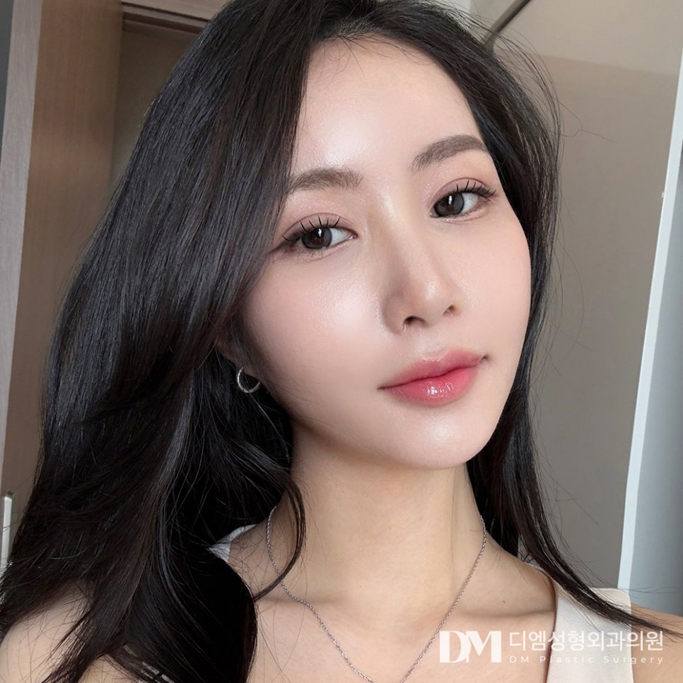When Is the Best Time to Have Revision Double Eyelid Surgery Again? image 1