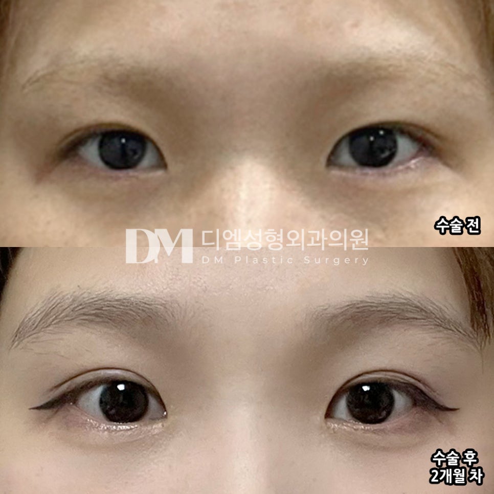 DM Reoperation for Eye Surgery Review, “I’m so happy with the procedure results!” image 2