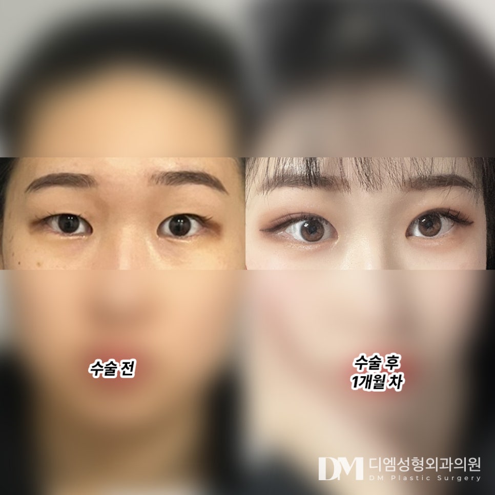 눈성형 후기."예뻐져서 좋아요 짱입니다 !" 관련 이미지 2
