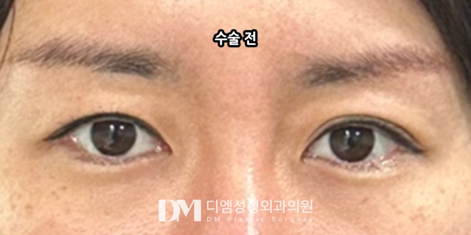 눈재수술, 실패의 흔적을 지우고 새롭게 시작하기 ! 관련 이미지 8