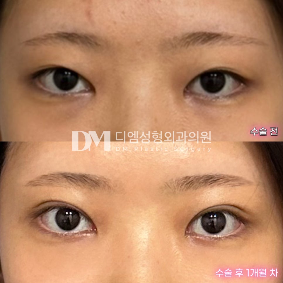 눈재수술 후기."의견을 적극적으로 수용해주셔서 좋았어요!" 관련 이미지 2