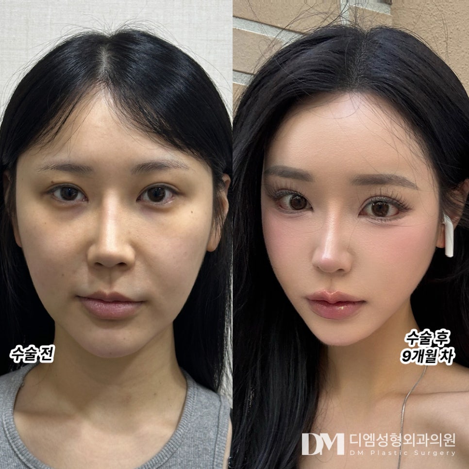 Plastic Surgery Review. "I’m satisfied that the double eyelid line is trendy these days and that there is no loss of fat even after 9 months!" image 2