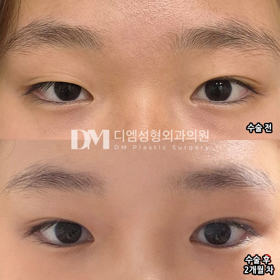 디엠 쌍꺼풀/눈성형 후기, “만족스럽고 추천합니다!” 관련 이미지 2