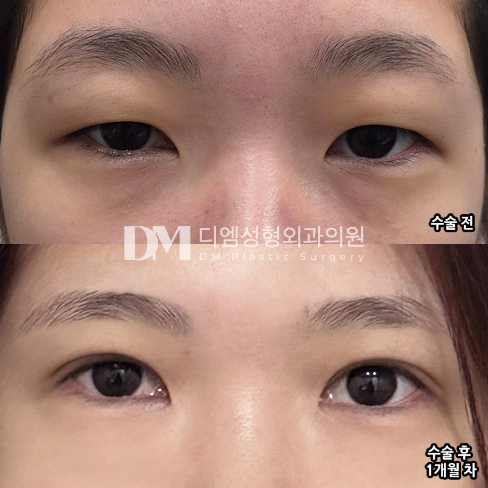 Double Eyelid Surgery: Create Eye Shapes That Stand Out with the Line That Suits You image 10