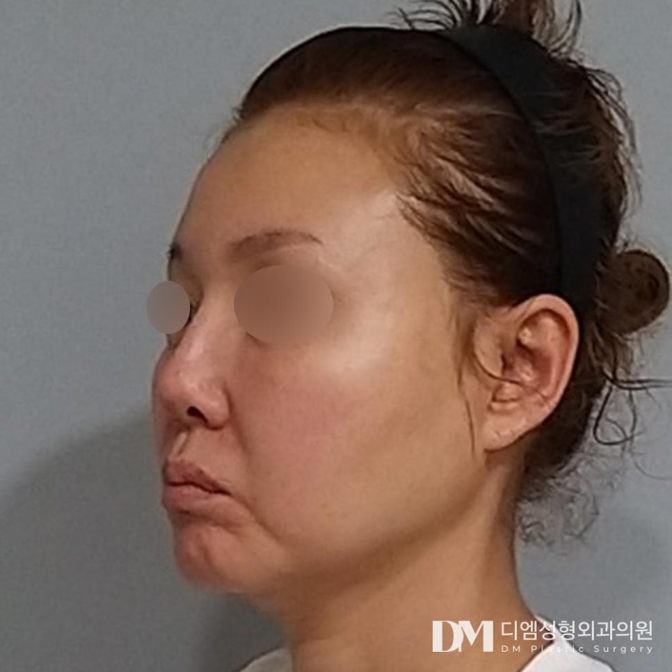 반거상, 중안면부의 처짐과 팔자,입꼬리 주름 개선에 최고! 관련 이미지 7