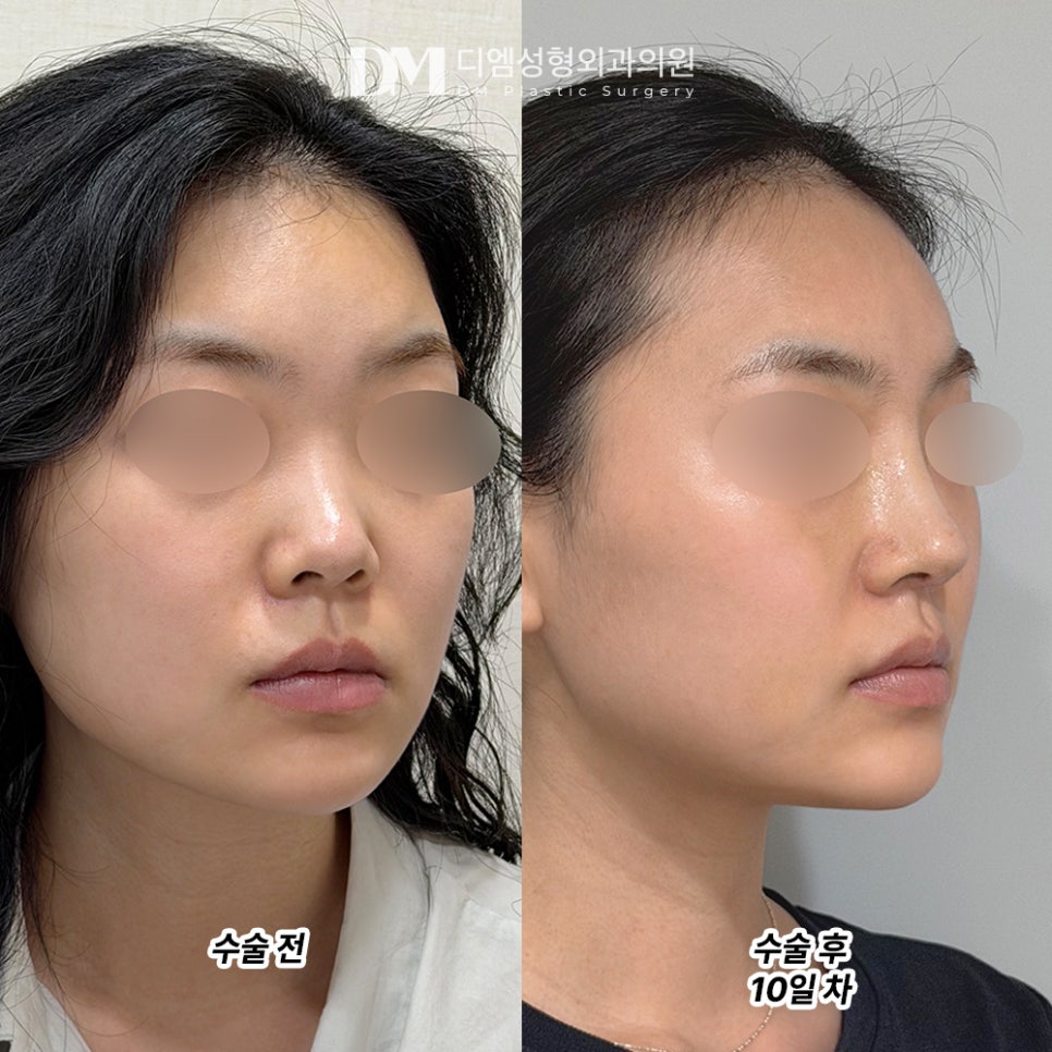 디엠 짧은코성형 후기, “얼굴 중심이 딱 잡혔고, 훨씬 성숙하고 여성스러워졌어요!” 관련 이미지 2