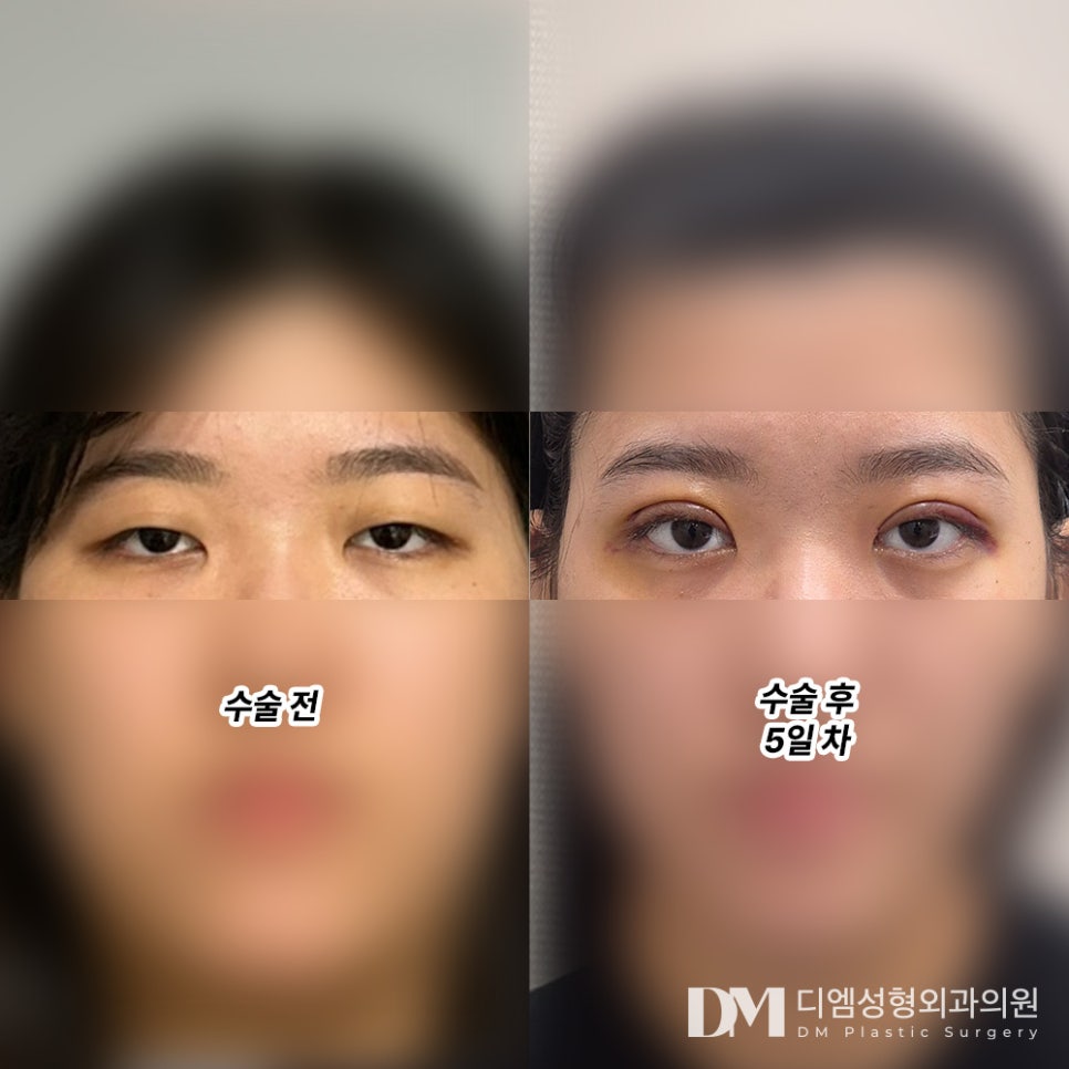 Blepharoplasty Review. "The line came out naturally and beautifully, so I’m really satisfied :)" image 2
