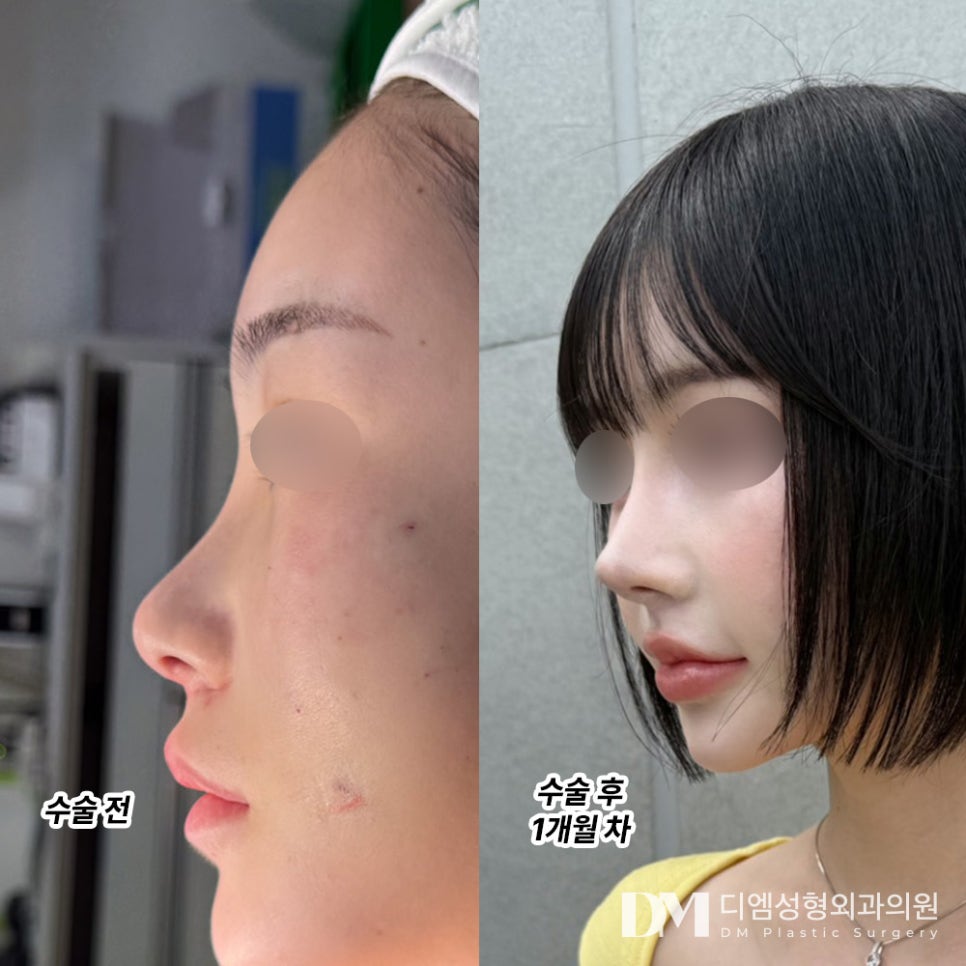 코재수술, 더욱 신중하게 접근하기 관련 이미지 10