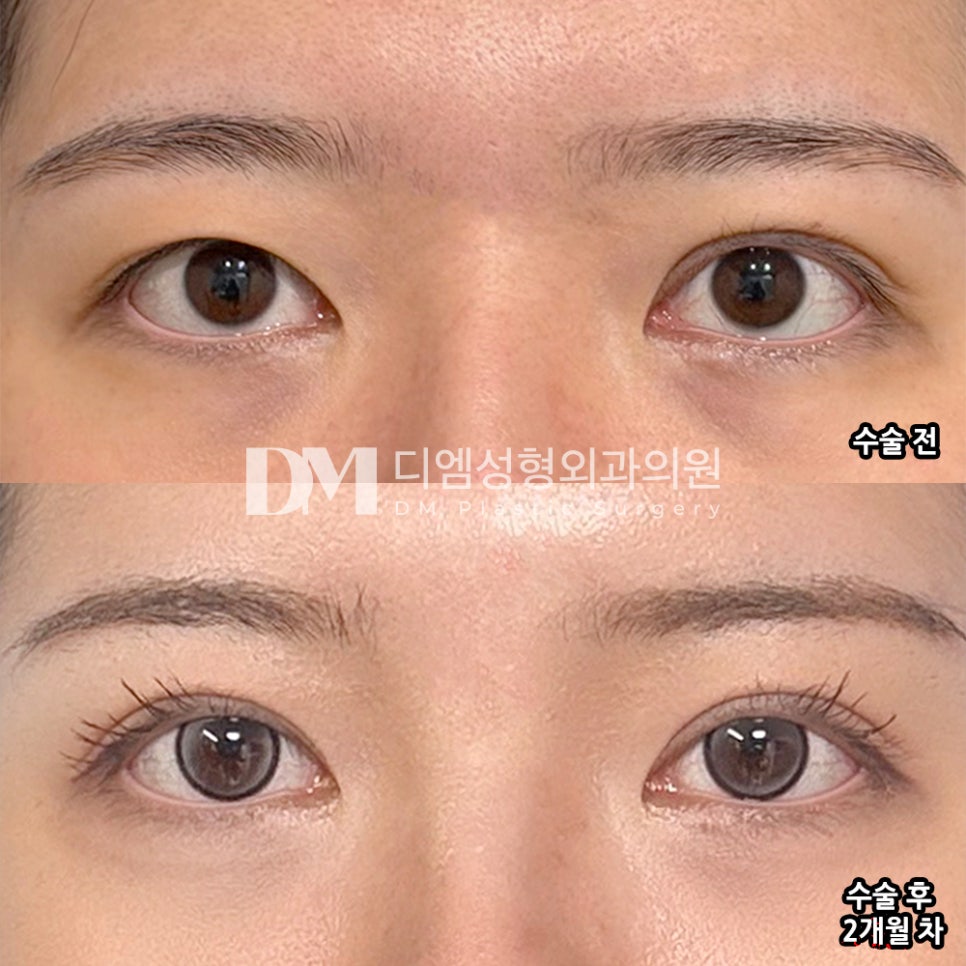 디엠 눈재수술/눈매교정 수술후기, “비대칭이 없어져서 너무너무 만족스러워요!” 관련 이미지 2