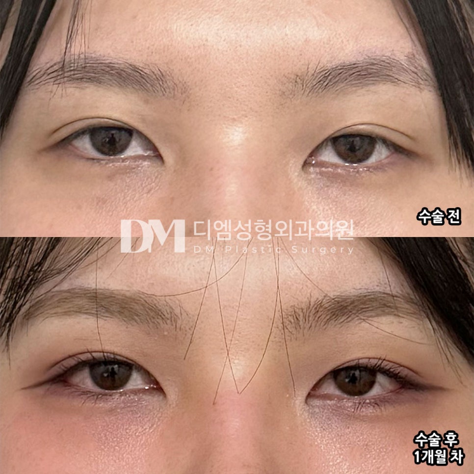 DM Lateral and Lower Canthoplasty Surgery Review, “I’m Satisfied with the Natural-Looking Results!” image 2