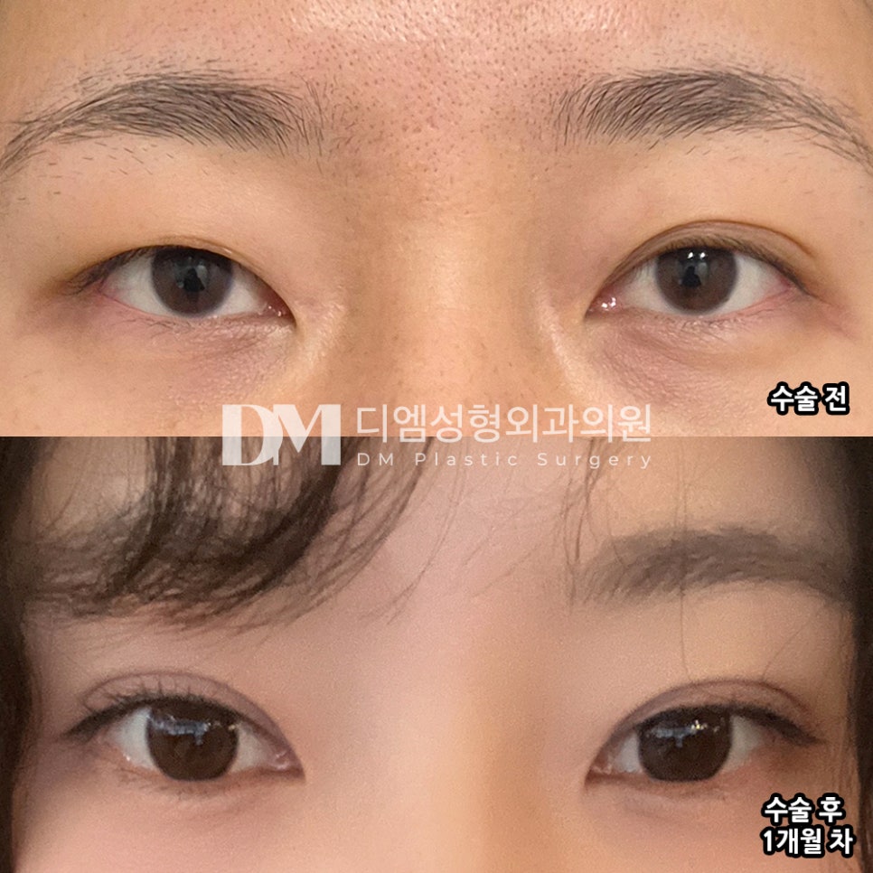 DM Revision Double Eyelid Surgery Review, &ldquo;I Like the Line Itself Too!&rdquo; image 2