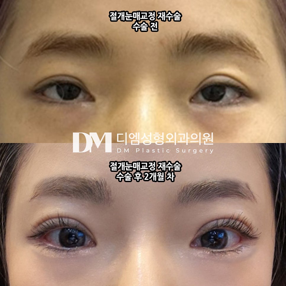 Revision Eye Surgery Review: “I Experienced No Discomfort, and the Staff Were Very Kind!” image 2