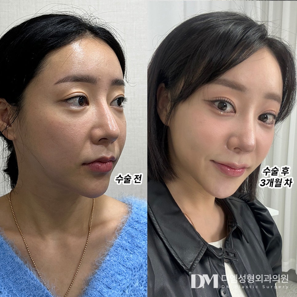반거상 후기."지금은 거울 볼 때 마다 기분이 좋아요 !" 관련 이미지 2