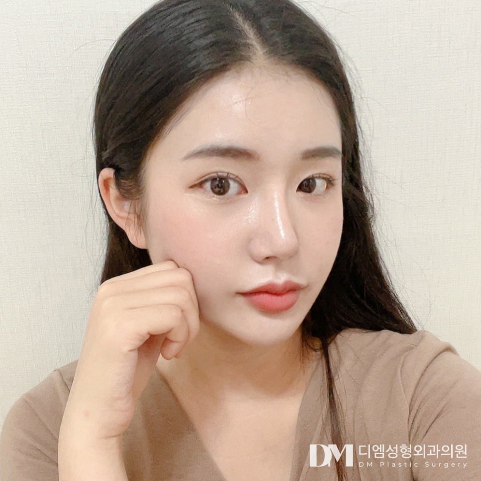디엠 빵트임 전후사진, 가로로 길어진 시원한 눈매의 비밀 관련 이미지 1