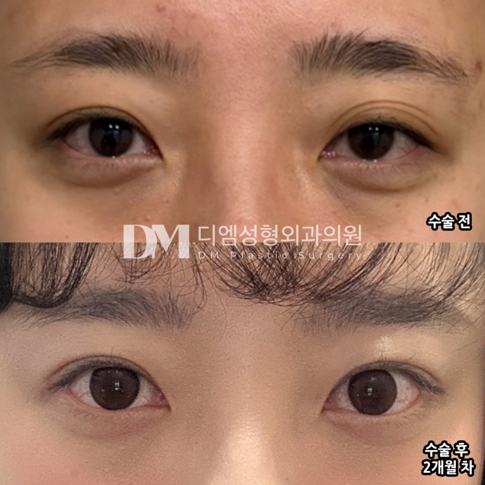 Eye Surgery Review: “I’m Satisfied That It Settled Nicely!” image 2