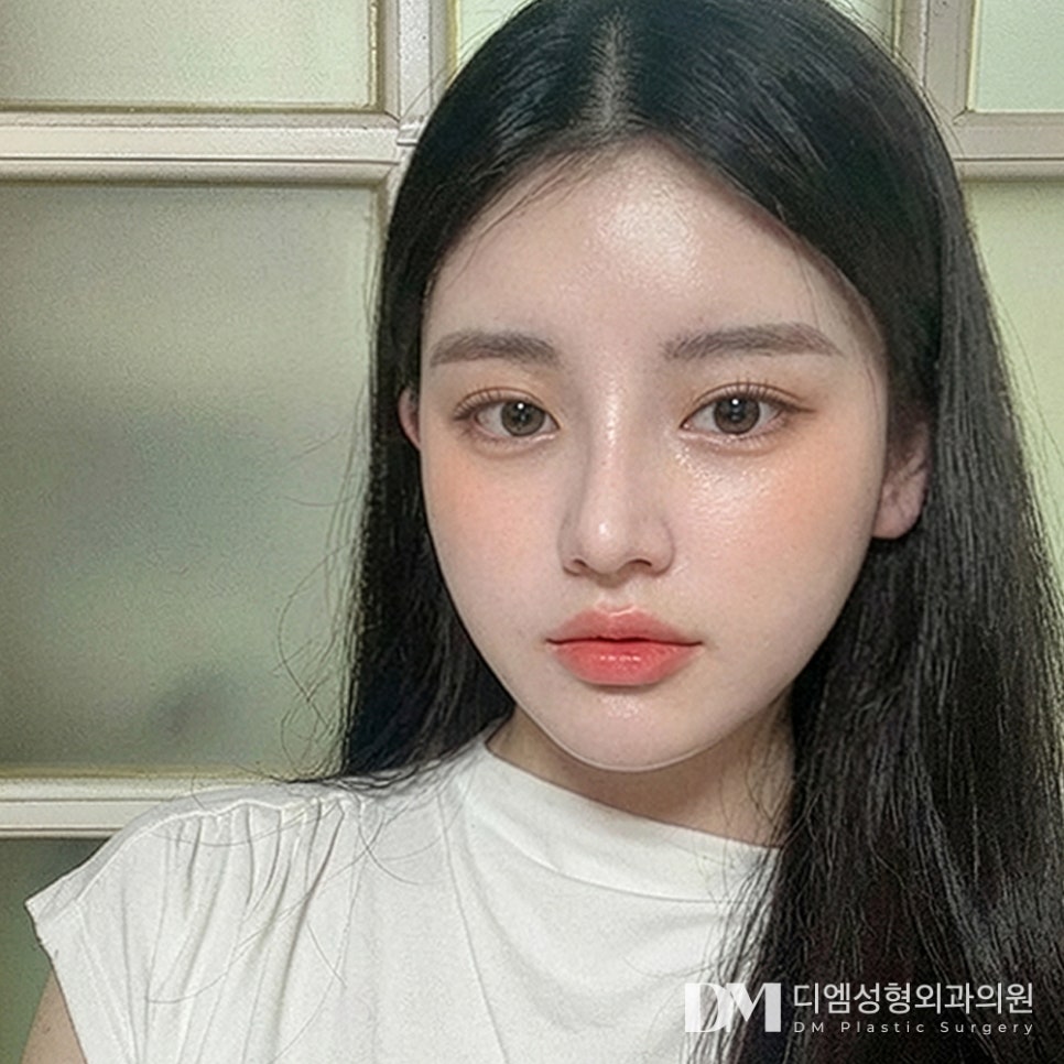 디엠 코성형 전후사진, 이목구비가 확 살아보이는 비결은? 관련 이미지 3