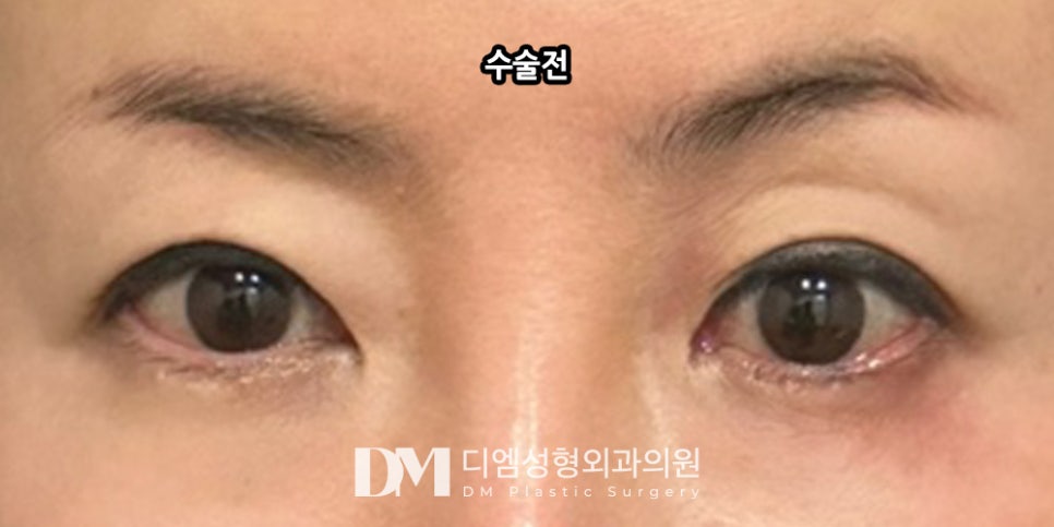 상안검, 처져 답답해 보이는 눈매 개선하기 관련 이미지 11