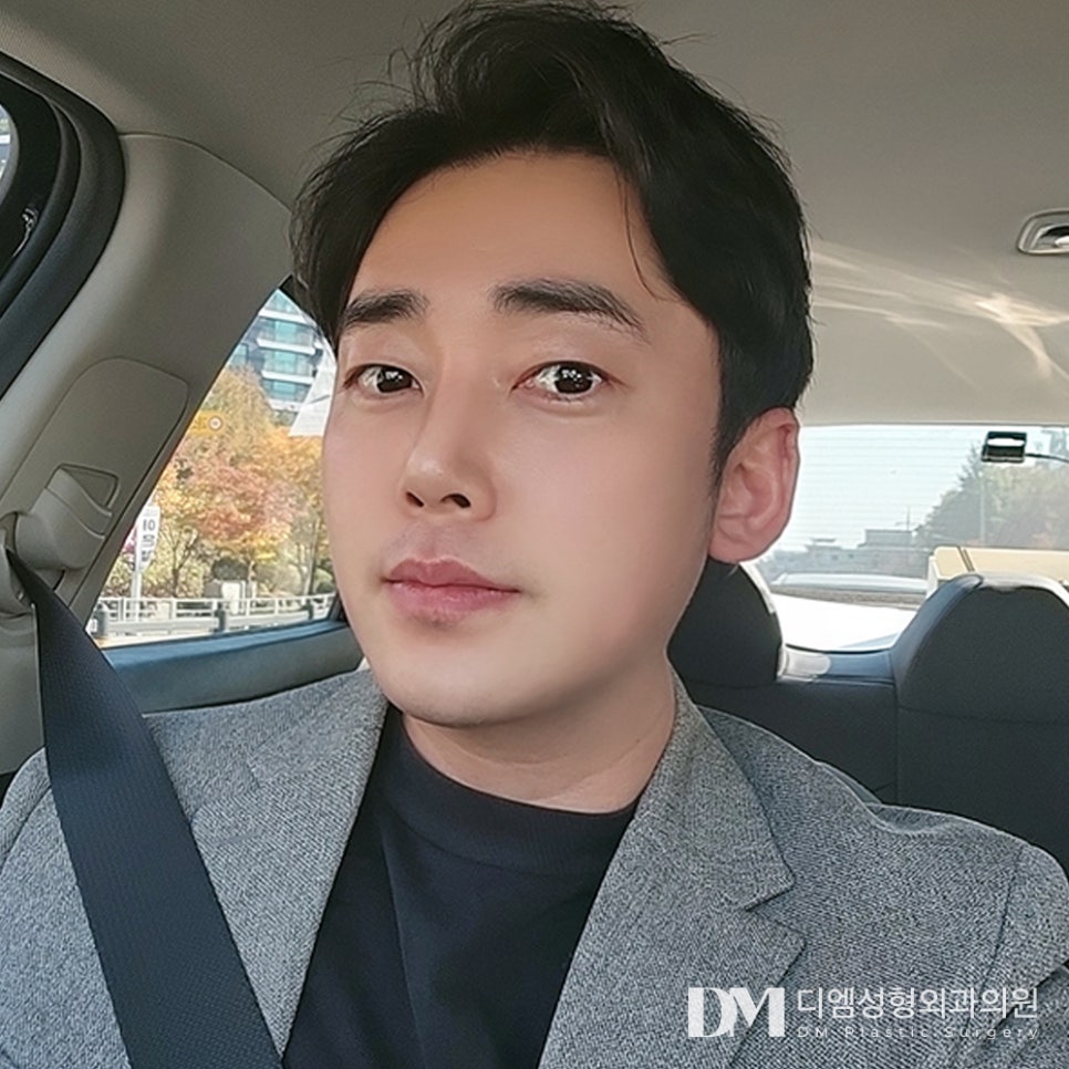 디엠 남자눈성형/남자눈매교정 전후사진, 부담스럽지 않게 눈매 개선을 원한다면! 관련 이미지 3