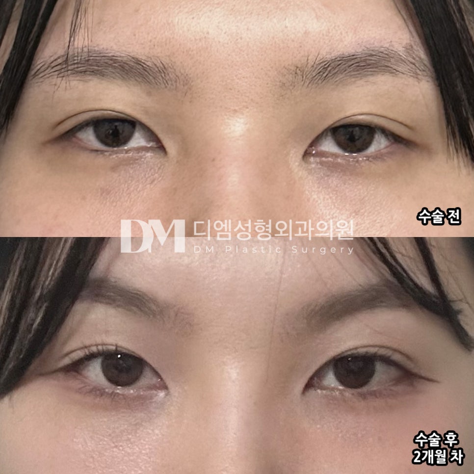 Ppangtwin Review. "I am very satisfied because the areas I had been worried about before the surgery seem to have improved" image 2