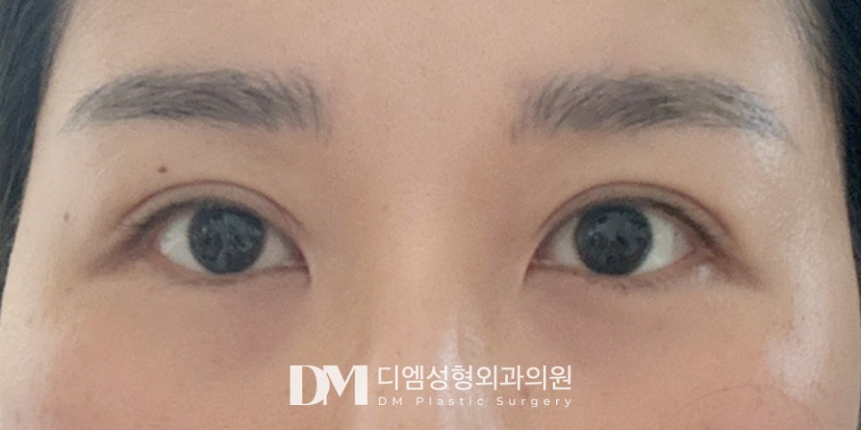 눈밑지방재배치 ,울룩불룩하고 칙칙한 눈밑이 고민이라면? 관련 이미지 7