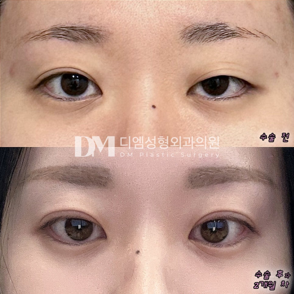 눈재수술 후기."제가 원한 자연스러운 라인이 너무 맘에들어요!!" 관련 이미지 2