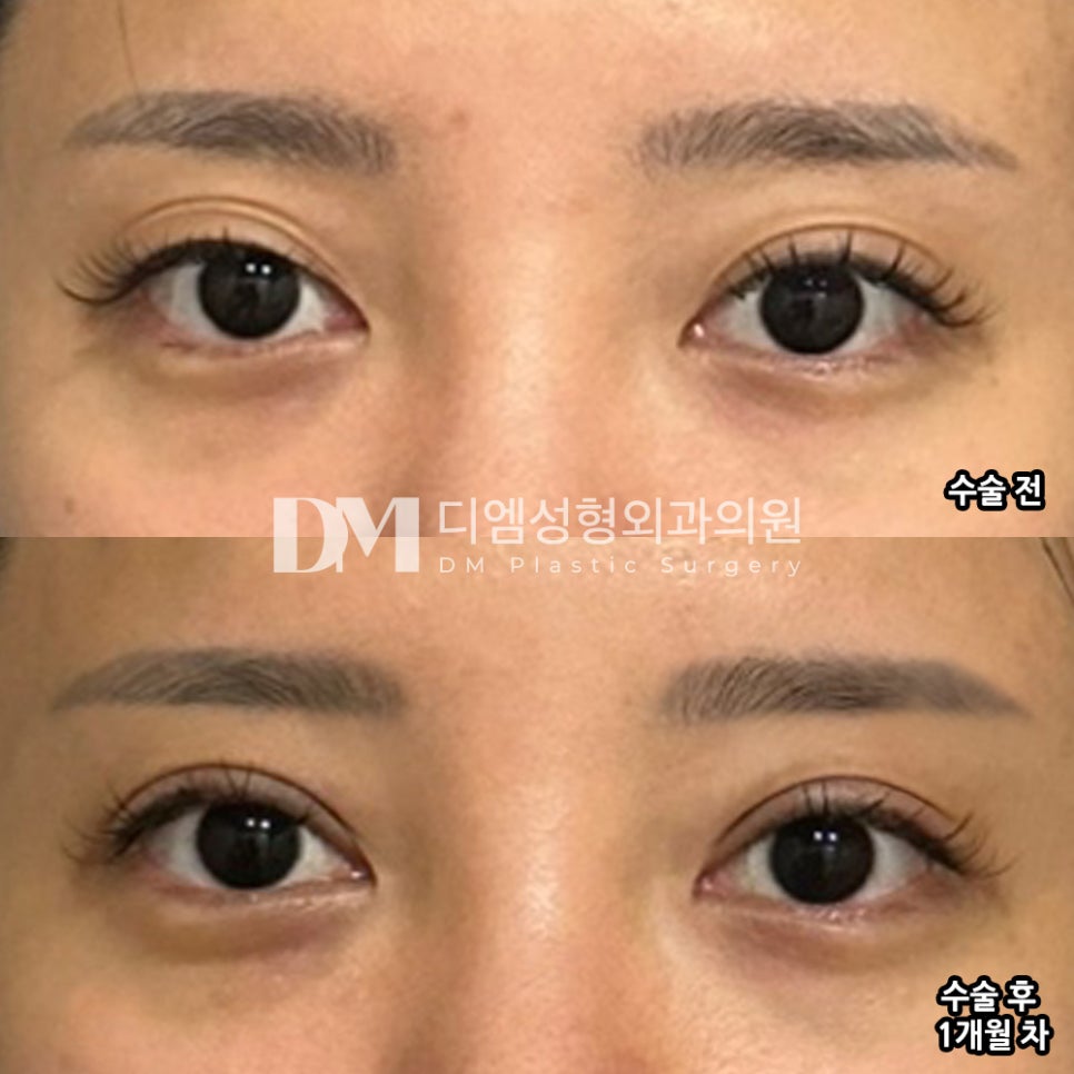 눈재수술 후기."전체적으로 너무 만족스러워요!" 관련 이미지 2
