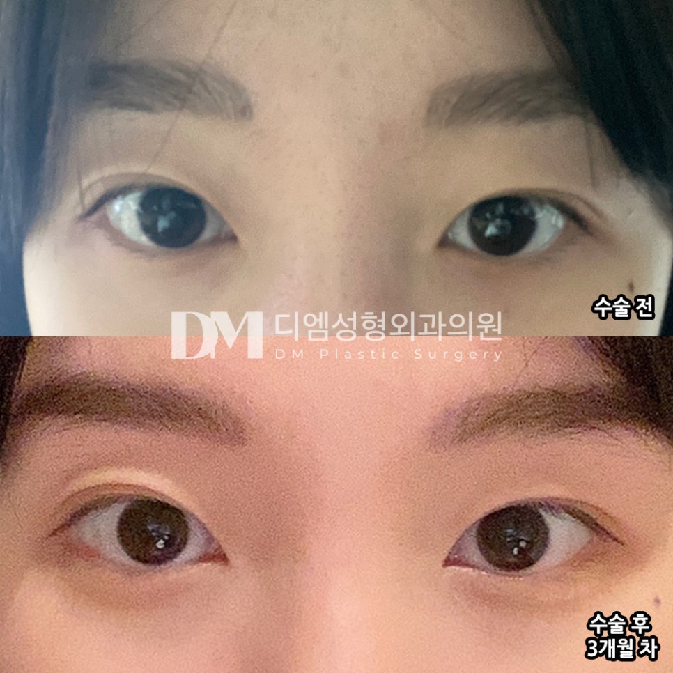 빵트임 후기."흉터도 거의없는편이고, 눈에 이물감도 전혀 없어요!" 관련 이미지 2