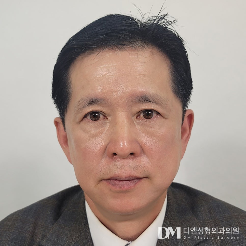 상안검, 처진 눈두덩이가 불편하다면? 관련 이미지 1