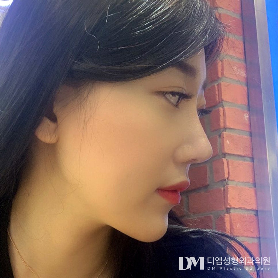 복코성형, 뭉툭한 인상 개선하기 관련 이미지 1