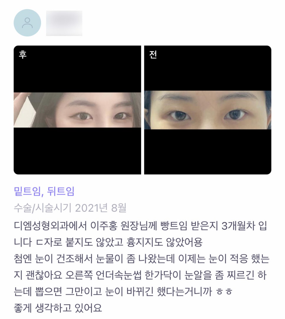 빵트임 후기."흉도 없고 붙지도 않아서 만족해요 !" 관련 이미지 1