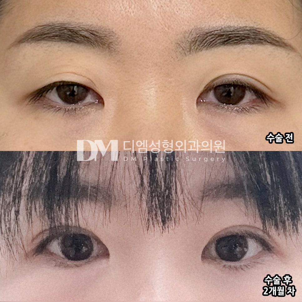 DM Revision Eyelid Surgery/Eye Contouring Correction Review, “I’m Satisfied Because You Created Such a Beautiful Line!” image 2