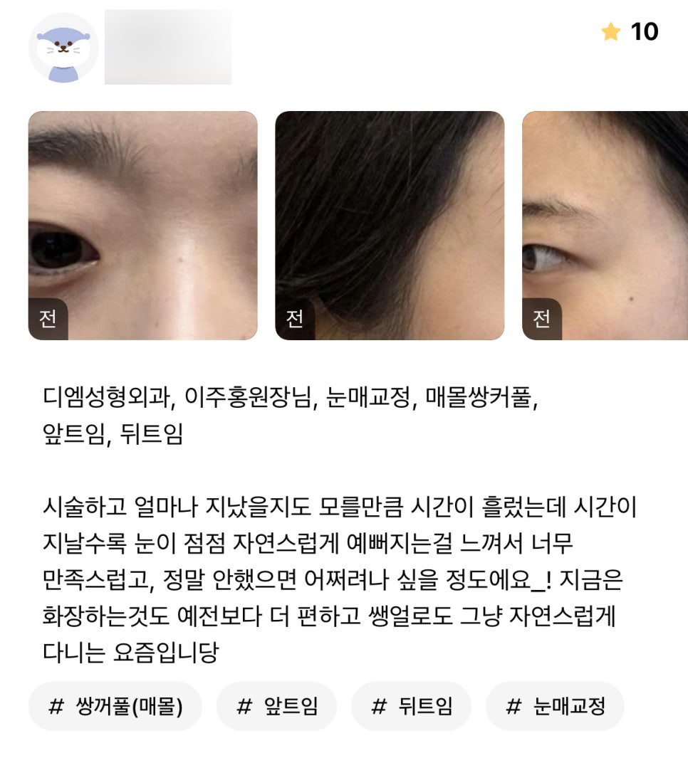 눈성형 후기."눈이 점점 자연스럽게 예뻐지는게 느껴져서 너무 만족이에요!" 관련 이미지 1