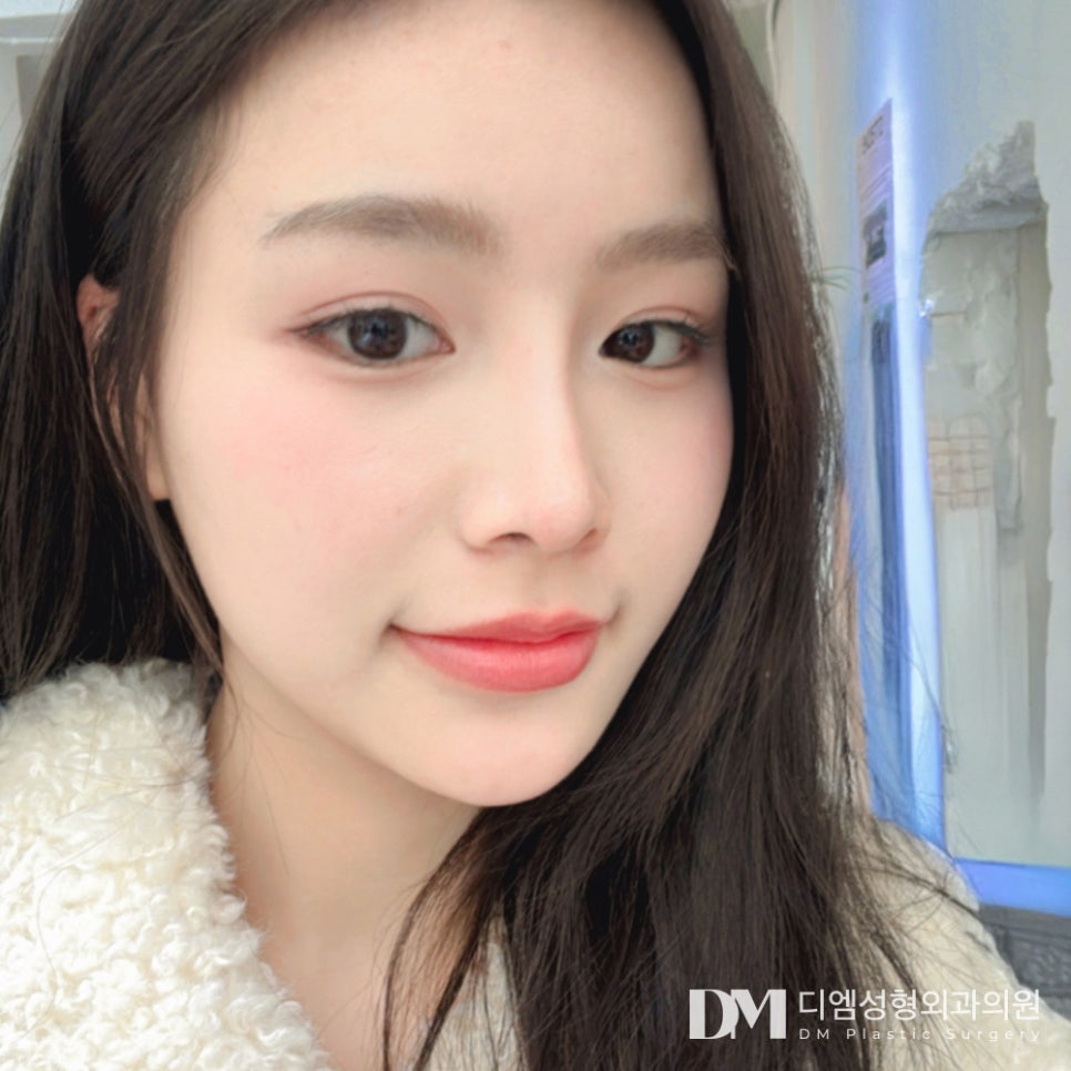 짧은코성형, 무조건 늘리고 높이기 보다 자연스럽게 맞춤형으로! 관련 이미지 11