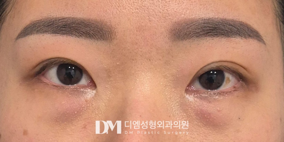 눈밑지방재배치, 피곤한 인상 볼록한 눈밑 개선 효과! 관련 이미지 6