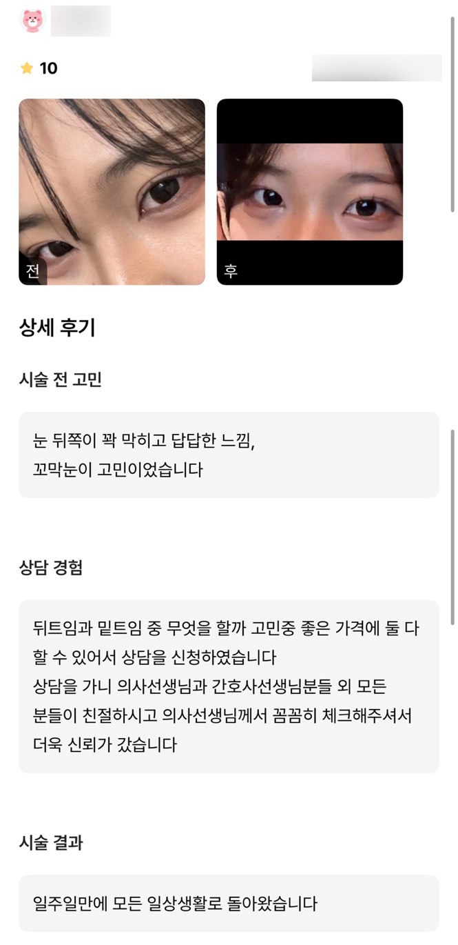Bbang Ttimum Review. "I was glad I could get two types of canthoplasty at a good price at the same time!" image 1