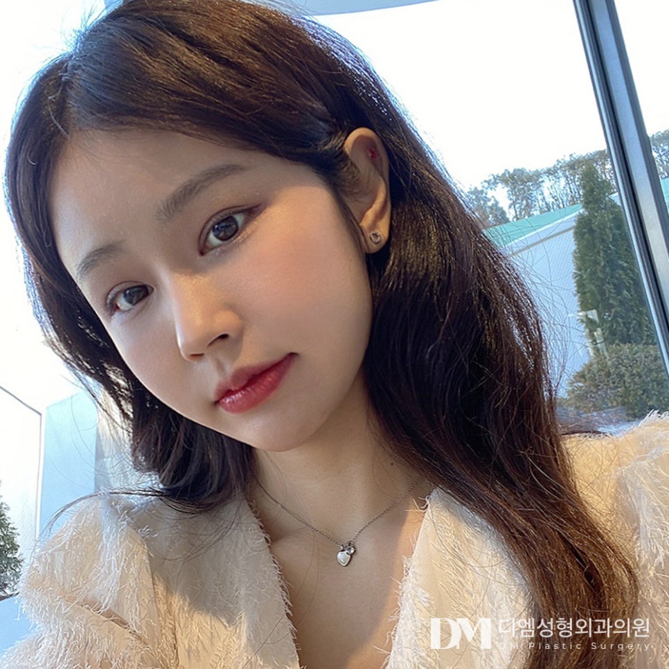 디엠 트임성형 전후사진, 전체적으로 시원한 눈매가 되고 싶다면! 관련 이미지 3