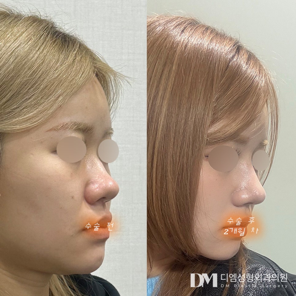Rhinoplasty Review. "It's not overdone and pretty, so I recommend it!" image 2