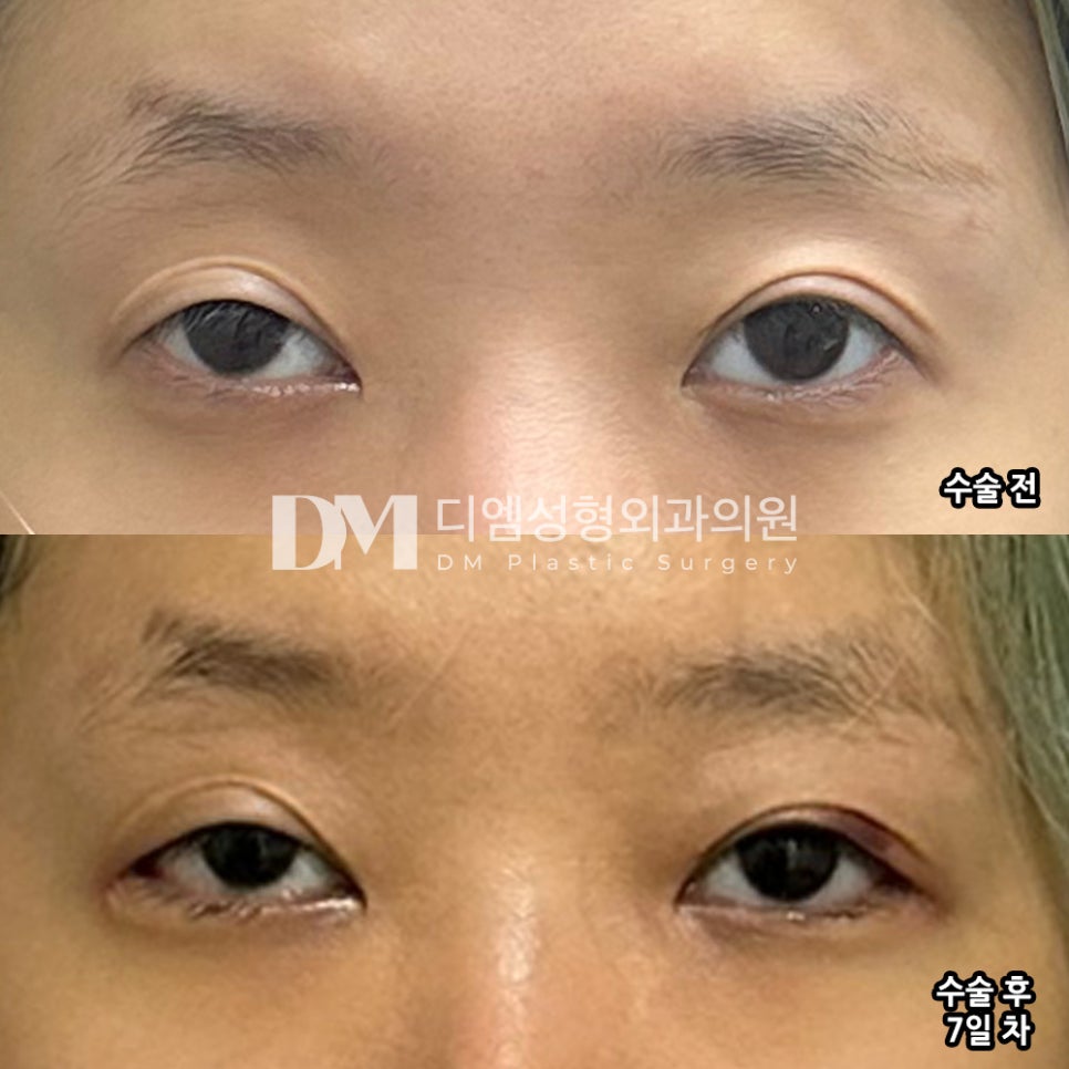 Corner Eye Surgery Review. "I'm satisfied because it seems to have opened up naturally and nicely!" image 2