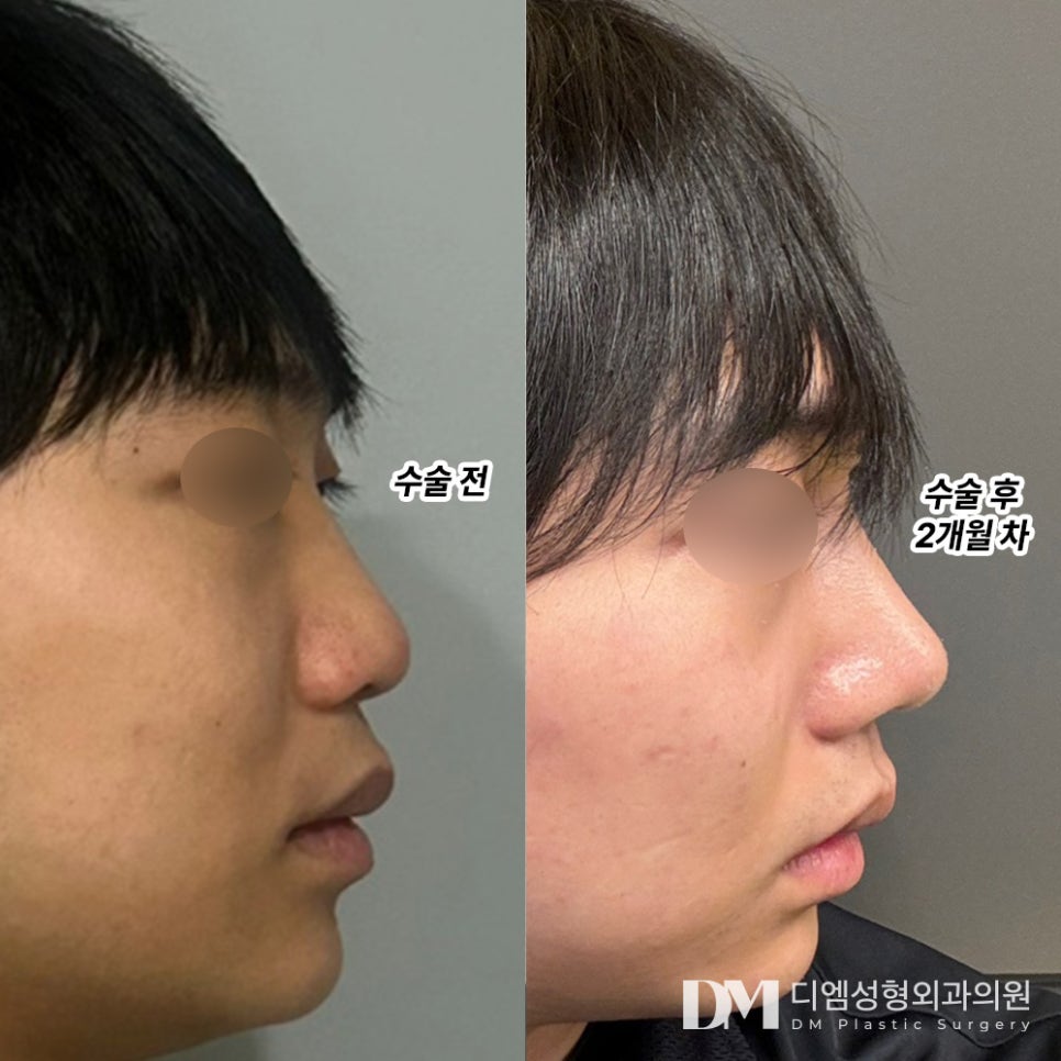 코성형 후기."붓기도 없고 통증도 없어서 너무 좋아요 !!!" 관련 이미지 2
