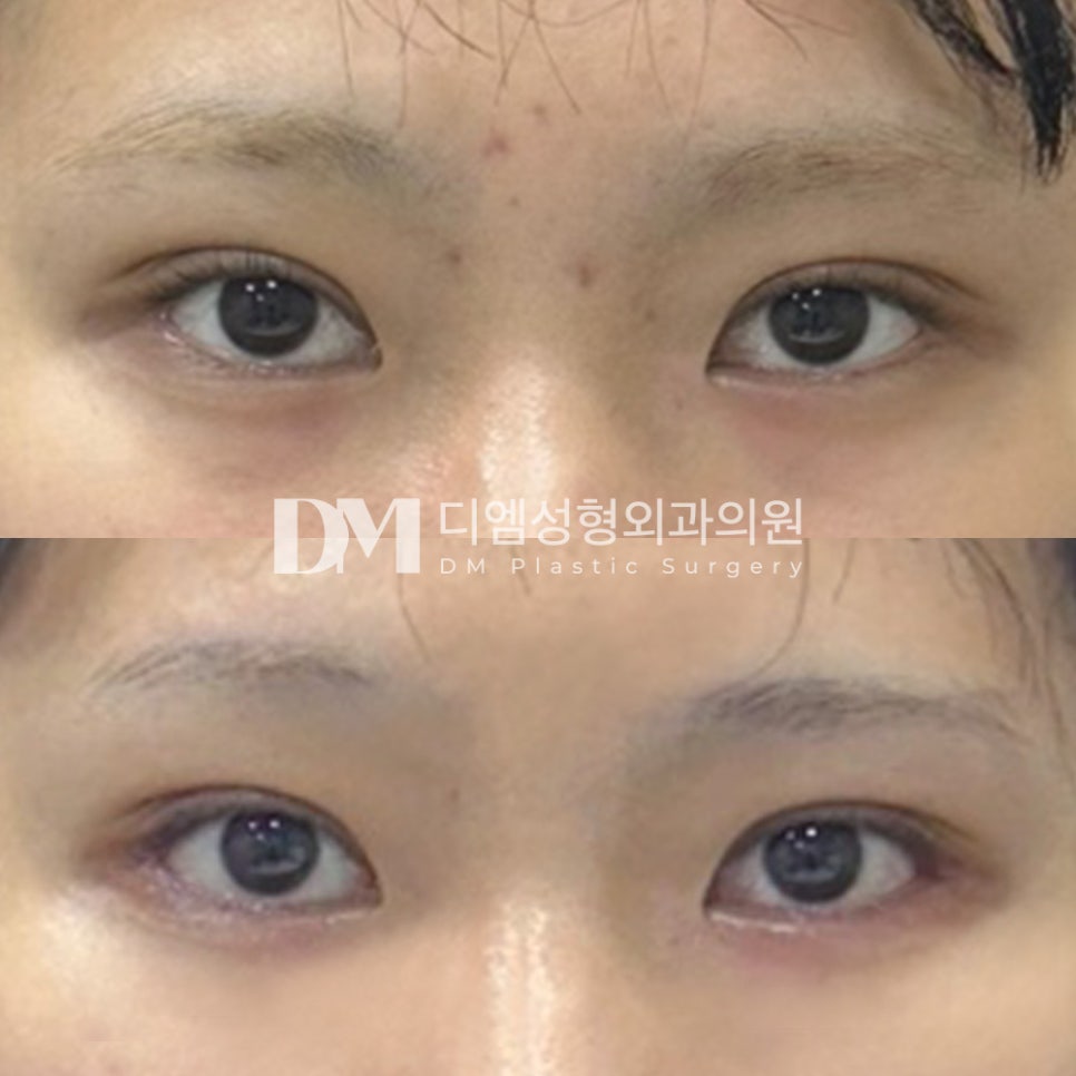 빵트임 후기."제가 원하던 눈매가 나온거 같아서 너무 만족중이에요!" 관련 이미지 2