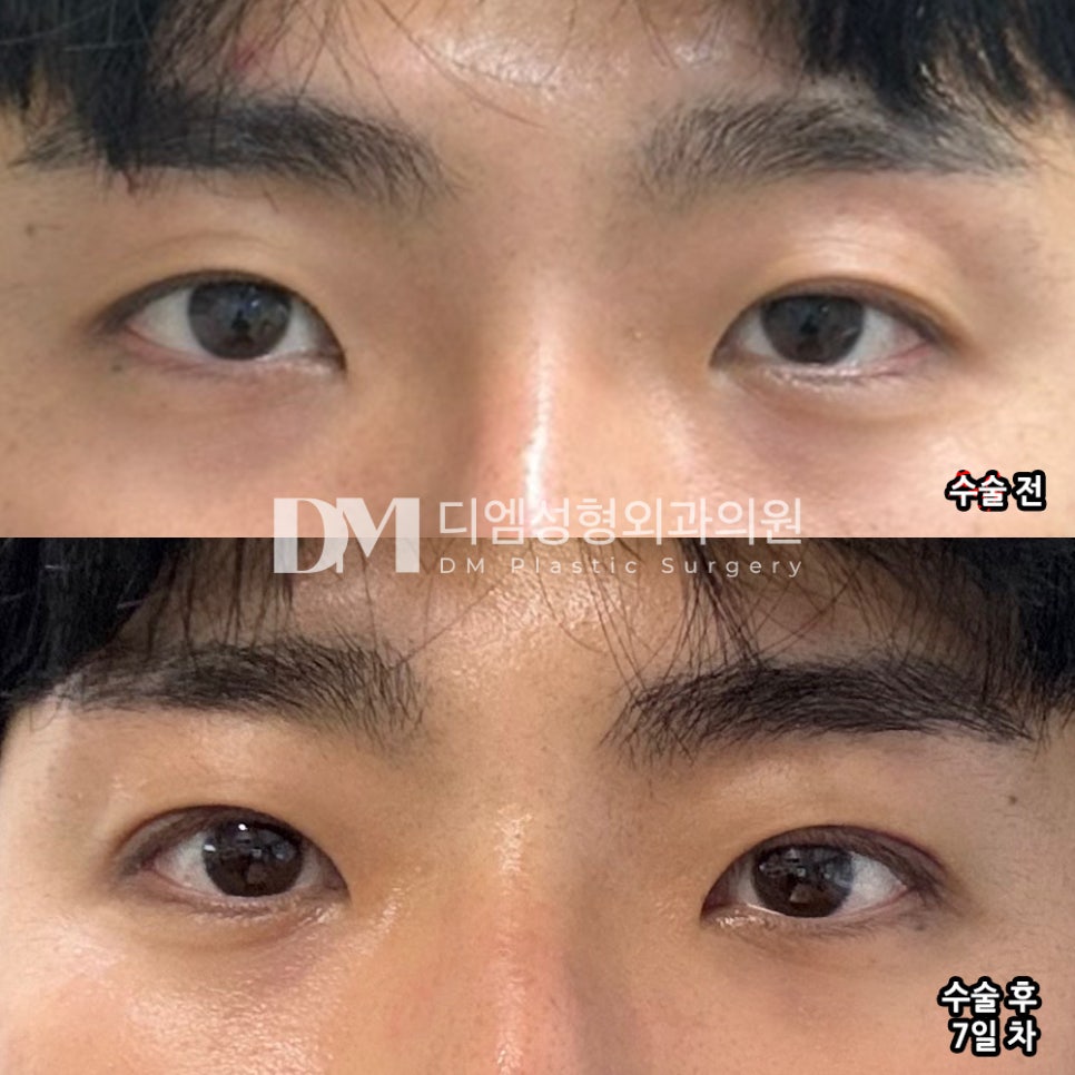 눈성형 후기."한달 후가 기대돼요!" 관련 이미지 2