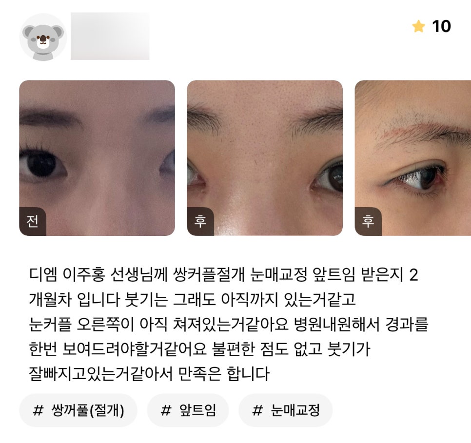 눈성형 후기."불편한 점도 없고 붓기가 잘 빠지고 있는거 같아서 만족 합니다 !" 관련 이미지 1