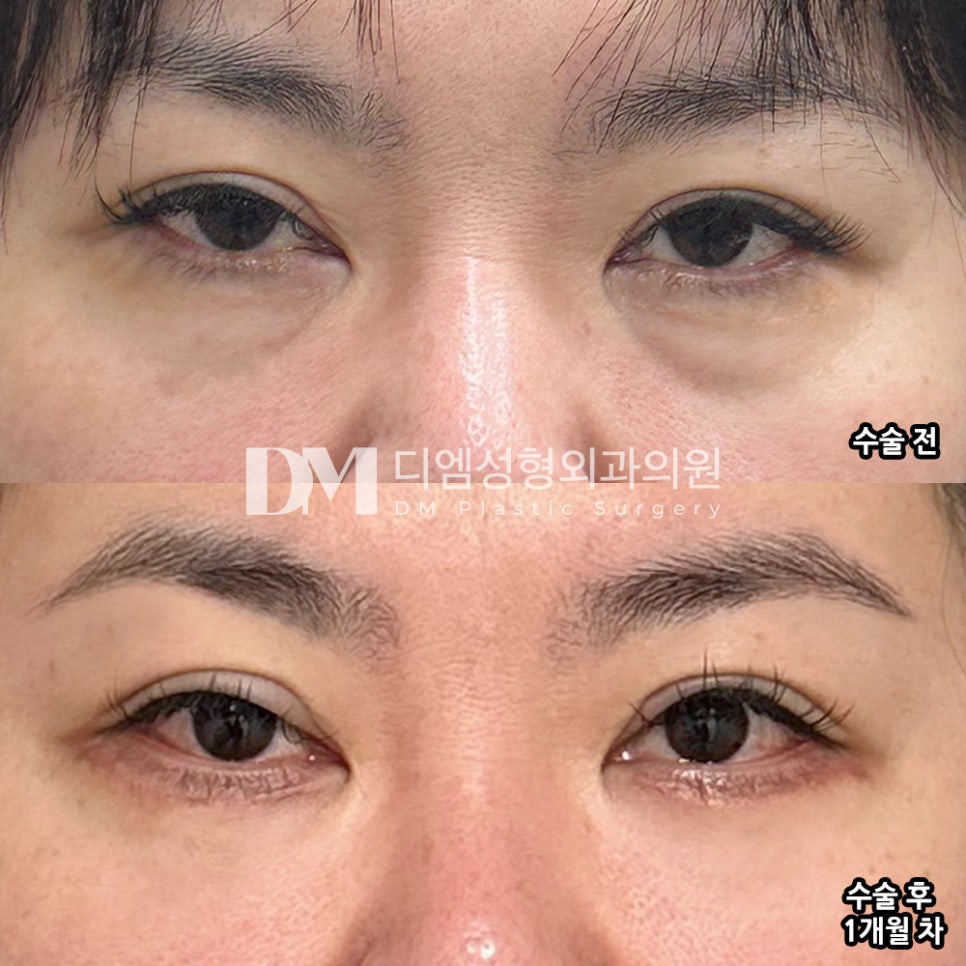 하안검 후기."통증이 거의 없어 좋았어요!" 관련 이미지 2
