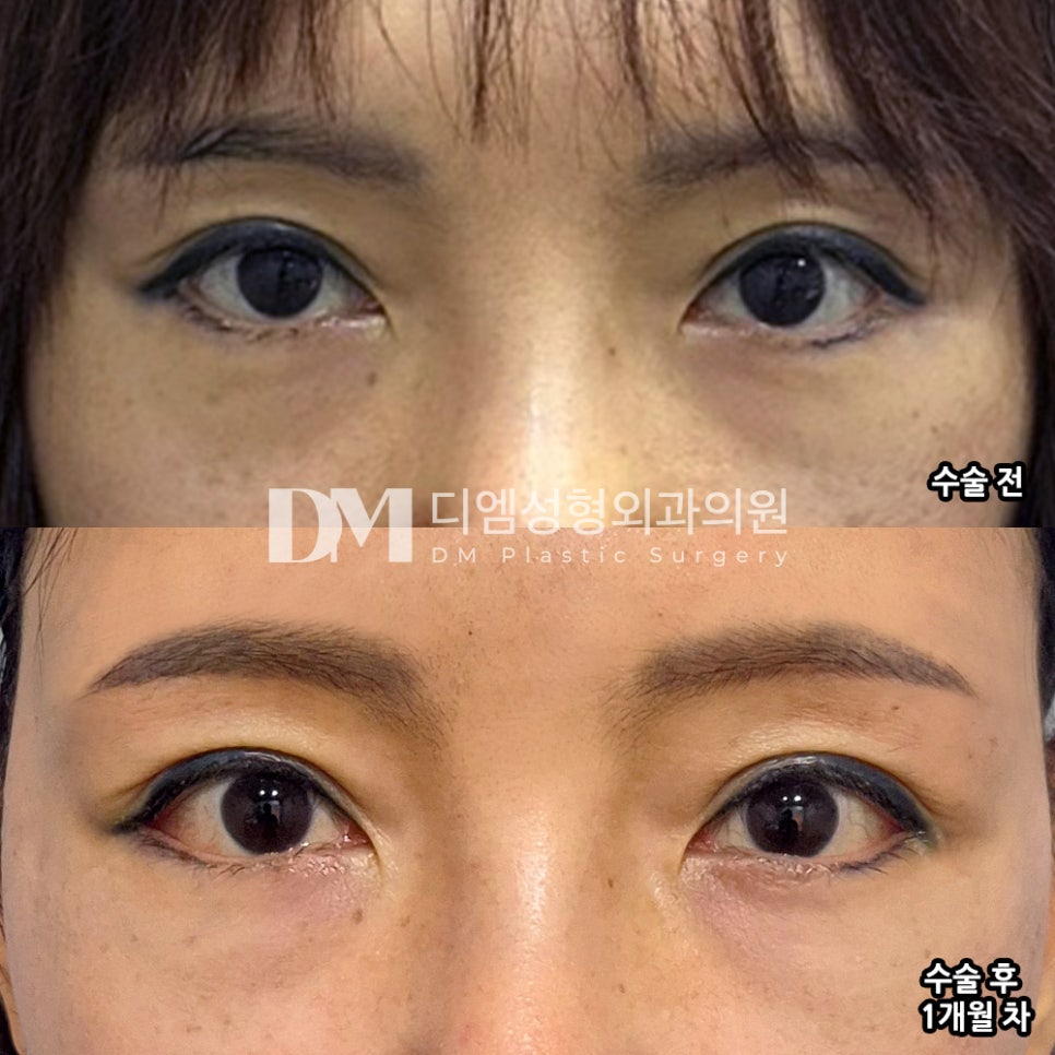 Blepharoplasty Review. "All of the staff are so, so kind!" image 2